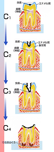 むし歯進行